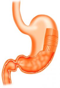 PPI-kidney