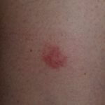 Herpes-zoster-new-drugs
