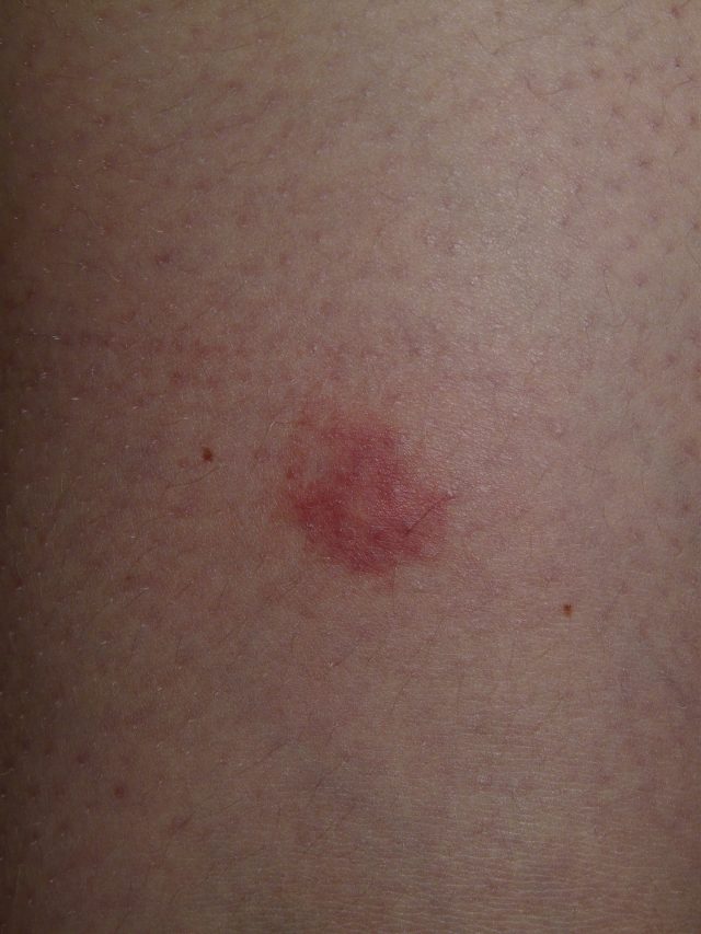 Herpes-zoster-new-drugs