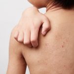 impetigo-contagiosa