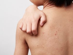 impetigo-contagiosa
