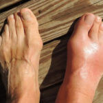 gout-allopurinol-effect-pain