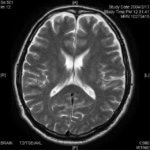 cerebral-infarction-cilostazol