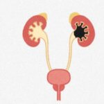 kidney-stones-magnesium