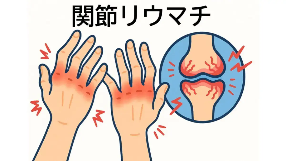 関節リウマチ