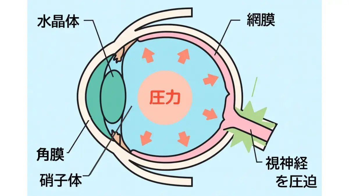 正常眼圧緑内障