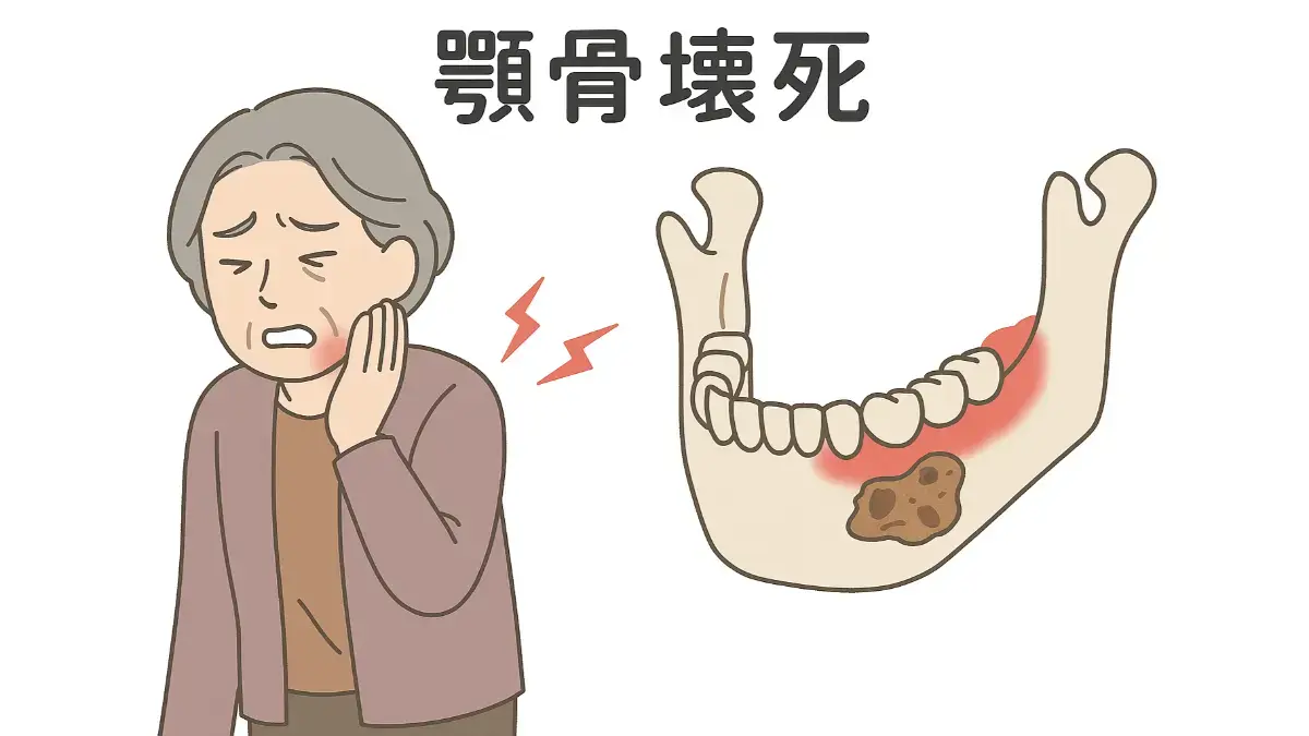 顎骨壊死