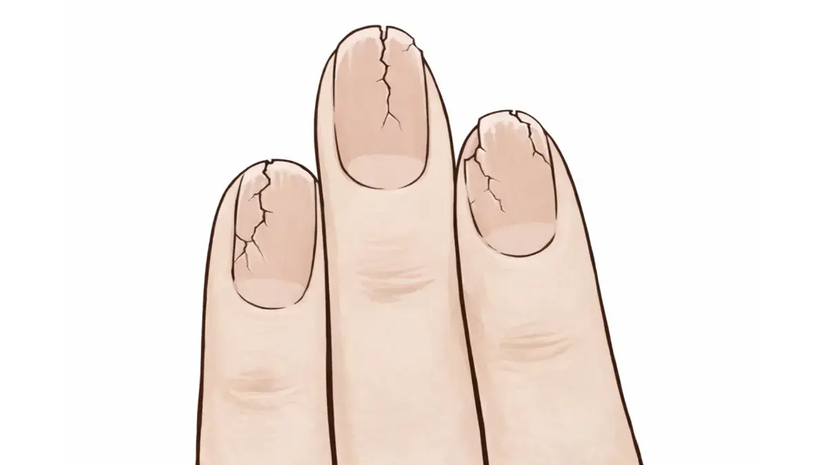 爪のひび割れイラスト