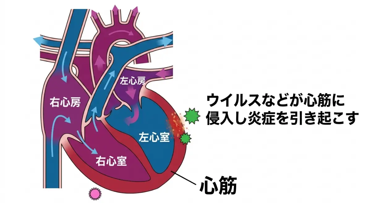 インフルエンザ心筋炎